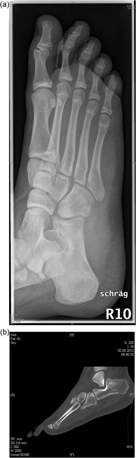 Cuboid Nutcracker Fracture In Children Management And Results Injury