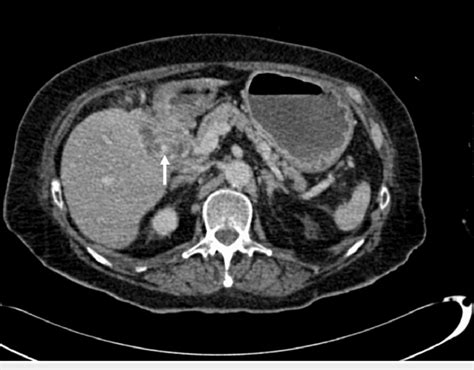 Axial Portal Venous Ct Shows Gallstone Fistulated Into The Duodenum
