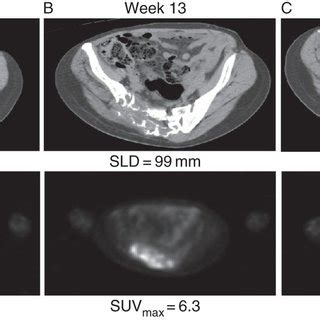 CT And PET Of Sacral GCTB Pre And Post Denosumab Treatment A