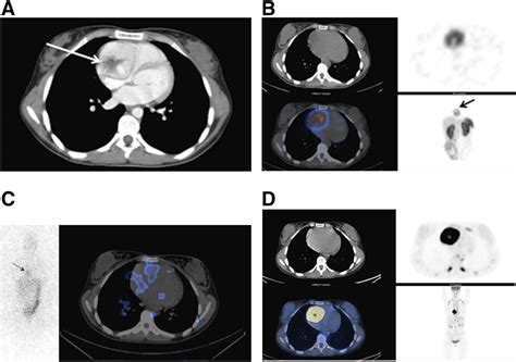Nuclear Imaging Of A Cardiac Paraganglioma Journal Of Nuclear