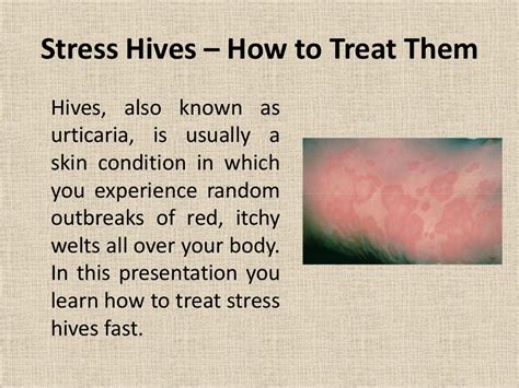 Stress Hives How To Treat Stress Hives Fast