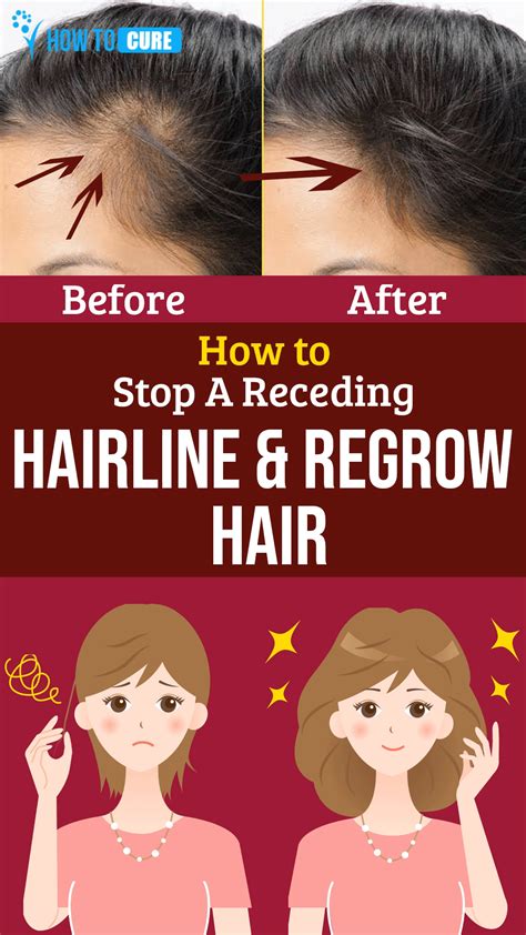How To Reduce Receding Hairline A Comprehensive Guide The 2023 Guide To The Best Short