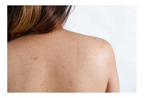 Six Ways To Get Rid Of Shoulder Acne The Standard Evewoman Magazine