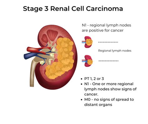 Kidney Cancer Stages Kccure Kidney Cancer Diagnosis Stages