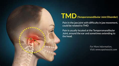 Tmd Treatment Exercises Tips Causes Symptoms Diagnosis