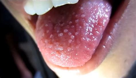 Painless Skin Colored Bumps On Back Of Tongue Pictures Lump On Labia The Best Porn Website