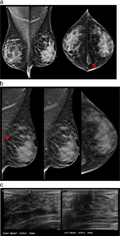 Digital Breast Tomosynthesis Of Gynecomastia And Associated Findings—a