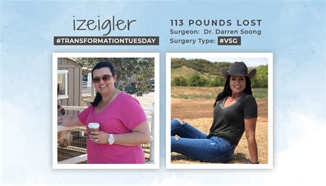Before And After Vsg With Izeigler Losing 113 Pounds Obesityhelp