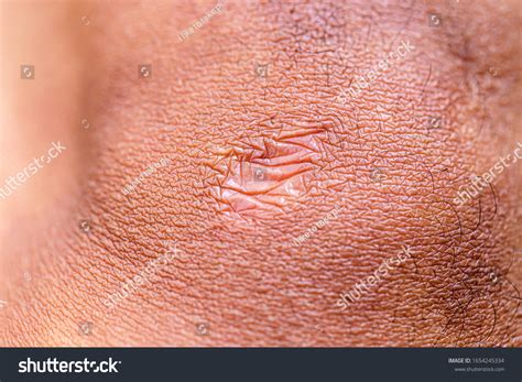 Close Cyanotic Keloid Scar Caused By Stock Photo Shutterstock