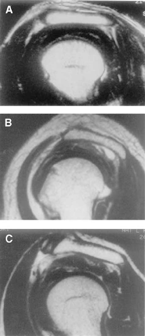 Acromial Shapes Determined By The Sagittal Oblique Plane On Mri Type I