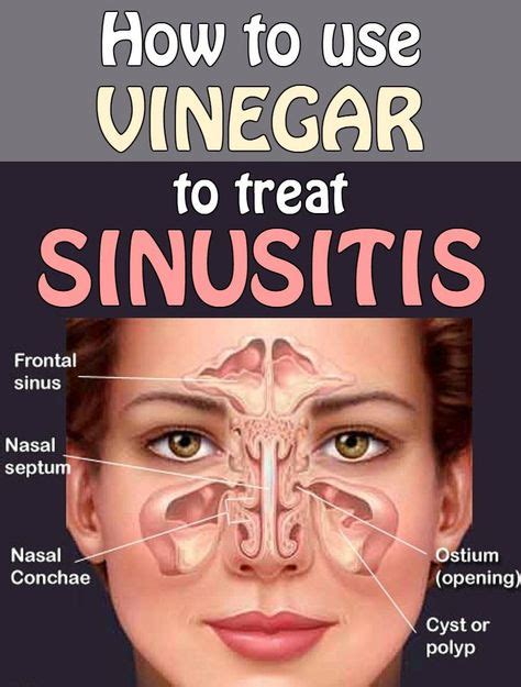 57 Best Sinus Drainage Ideas Sinusitis Sinus Remedies Health Remedies