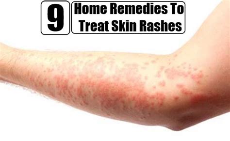 Top 9 Home Remedies To Treat Skin Rashes Home Remedies For Rashes