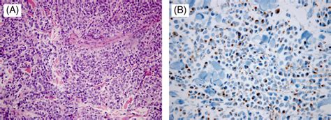 Histopathology Of Merkel Cell Carcinoma A Dermal Neoplasm Composed Of