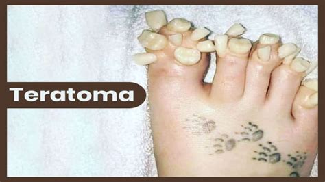 Teratoma Types Symptoms Causes Diagnosis And Treatment Boldsky Com My