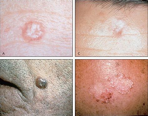 What Is The Best Treatment For Squamous Cell Carcinoma