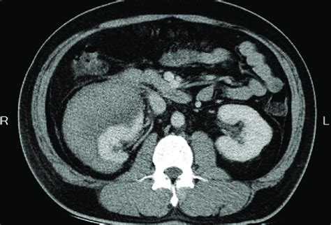 Computed Tomography Showing A Perirenal Hematoma Of Increased Density