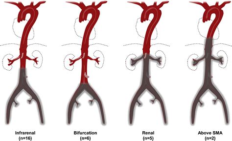 A Modern Series Of Acute Aortic Occlusion Journal Of Vascular Surgery