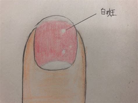 The latest tweets from acaね (ずっと真夜中でいいのに。) (@zutomayo). 爪に白い斑点ができる原因と対処法!幸運のサインではない ...