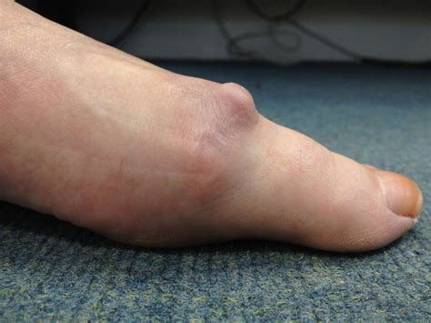 Big Toe Arthritis Arthritis On The Big Toe Joint Hallux Rigidus