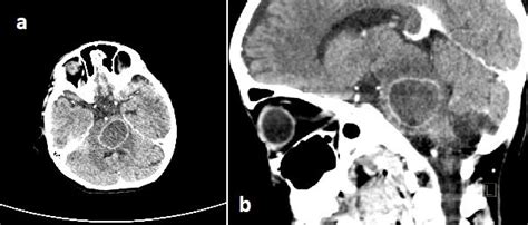 Ct With Contrast A Axial And B Sagittal Reconstruction Showing