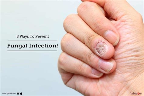 8 Ways To Prevent Fungal Infection By Dr Vignessh Raj Lybrate