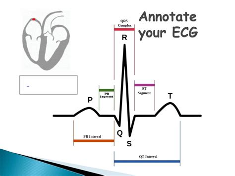 Ppt Annotate Your Ecg Powerpoint Presentation Free Download Id5095631