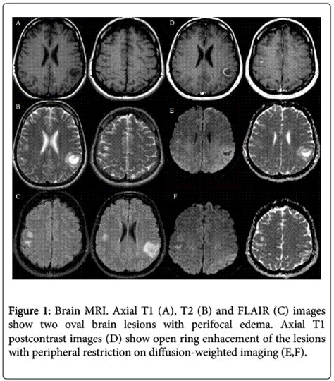 Multiple Sclerosis Brain Mri