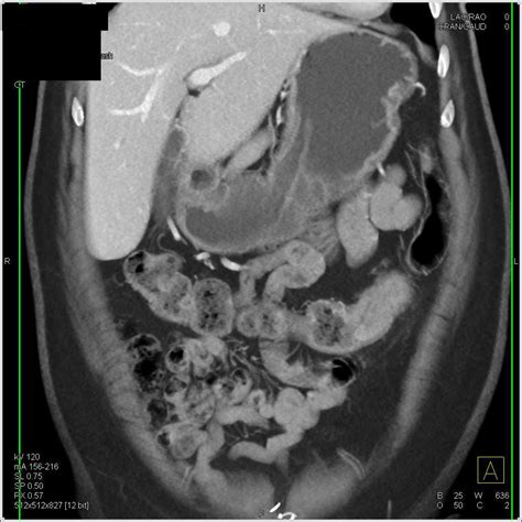 Transverse Colon Cancer In Patient With Long Standing Ulcerative