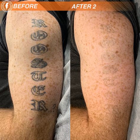 The Tattoo Removal Co Laser Tattoo Removal Adelaide