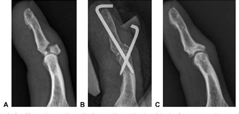 Figure 3 From The Outcomes Of Extension Block Pinning And Nonsurgical