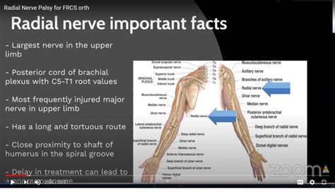 Radial Nerve Injuries For The Frcsorth Exam —