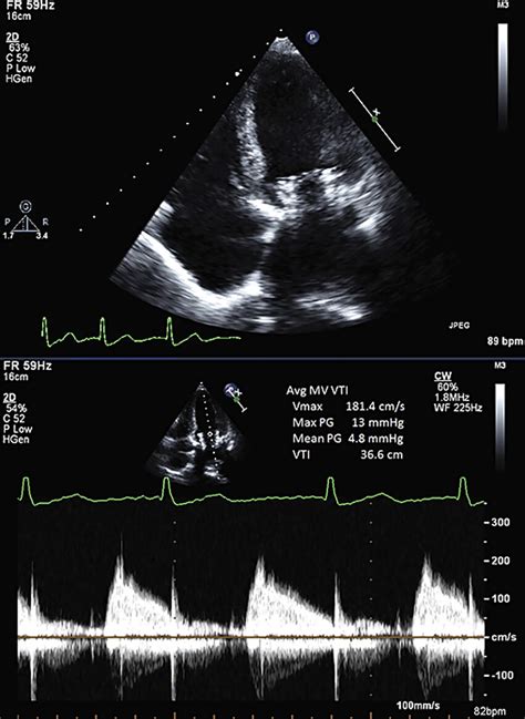 Post Procedure Transthoracic Echocardiogram Download Scientific Diagram