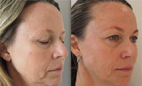 Rejuvenations Facial Aesthetic Clinic Anti Aging Treatments