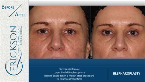 Blepharoplasty Dr Erickson Dermatology