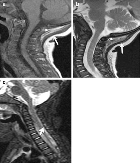 Normal Appearance Of Nuchal Ligament And Suboccipital Region On Mri A