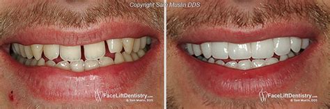 Other people develop gap teeth once their permanent teeth start erupting. Wider Smiles with No-Drilling Veneers