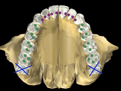 Lighter Anterior Tooth Contacts Lee Ann Brady Dmd