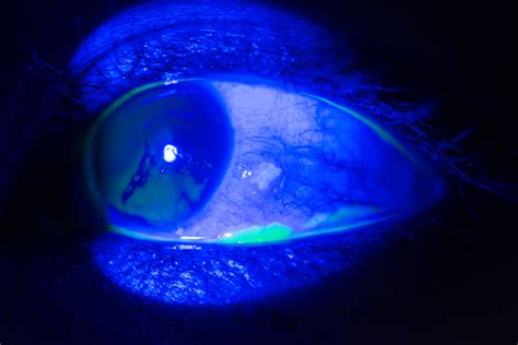 Scleritis And Episcleritis Eye Patient