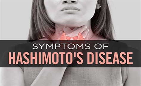 Symptoms Of Hashimotos Thyroiditis Beemed