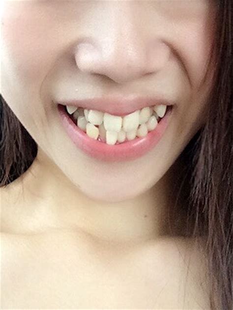 わたしの歯並び※歯の写真注意！ 22歳の歯列矯正