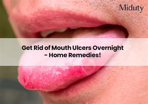 Get Rid Of Mouth Ulcers Overnight Home Remedies Miduty