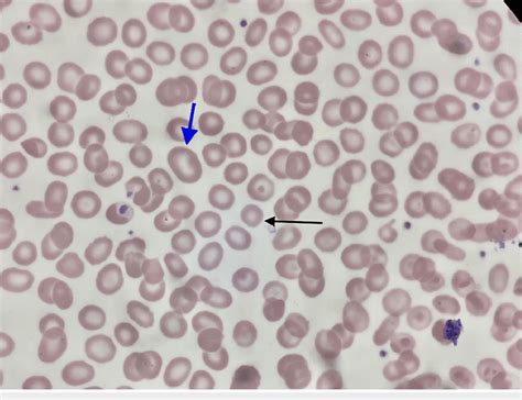 Peripheral Blood Film Microscopic View Showing A Mixed Picture Of
