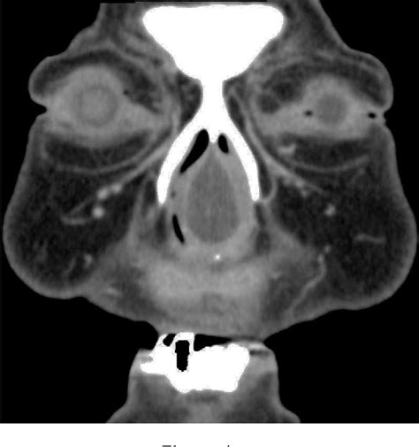 Figure 1 From A Nasal Septal Abscess Semantic Scholar