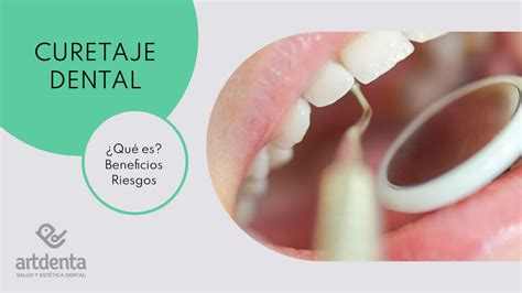 Curetaje Dental ¿qué Es Beneficios Y Riegos Clínica Dental En