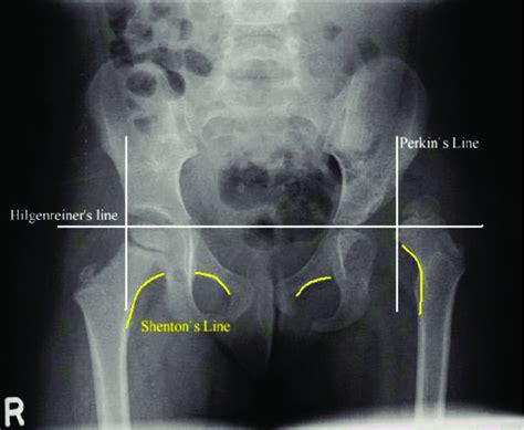 Pelvis X Ray Ap View Showing Left Sided Dysplastic Hip With Femur