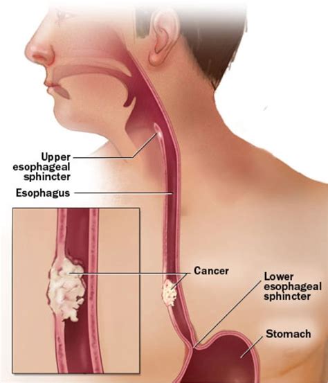 Esophageal Spasm Causes Symptoms Treatments And More