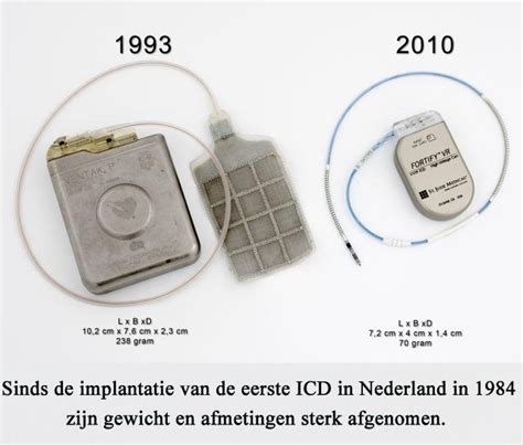 Aftercare pacemaker placement icd 10show all. Wat is een ICD? - Stichting ICD dragers Nederland