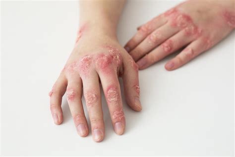 Dermatitis De Contacto Alergomed