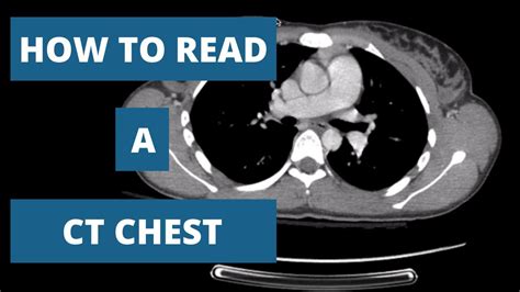How To Read A Ct Scan Chest A Radiologists Approach Youtube