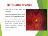 Optic Nerve Neuropathy Treatment Photos